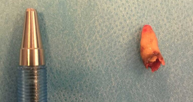 Kazuistika představuje vzácný výskyt retinovaného zubu v nosní dutině