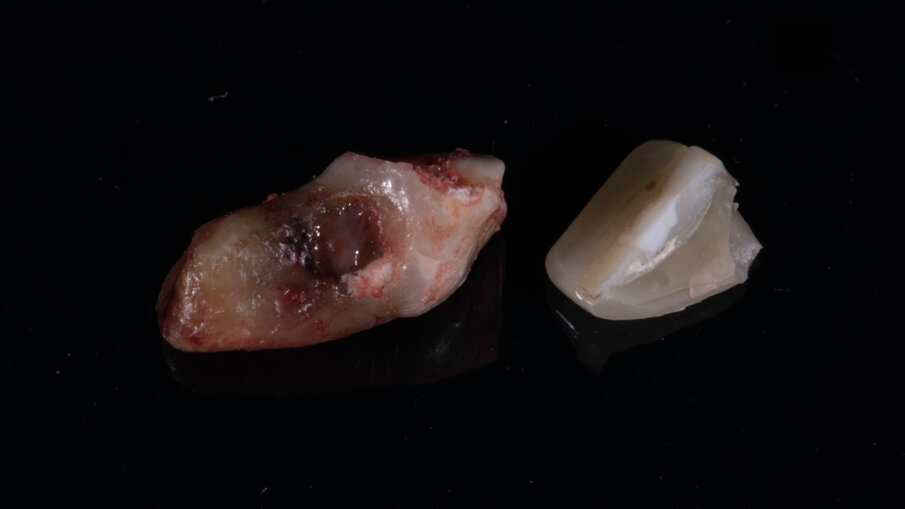 Fig. 12_Dente 1.1 estratto.
