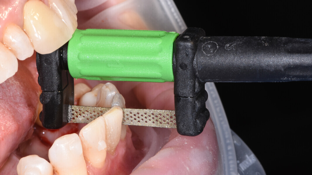 Fig. 9: Interproximal reduction with FitStrip.