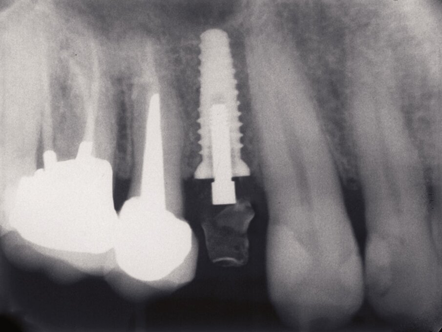 Fig. 2a_Fase protesica provvisoria. Rx endorale di controllo in cui si nota il perfetto posizionamento implantare.