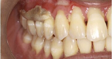 Osteonecrosis maxilar por medicamentos no bifosfonatos