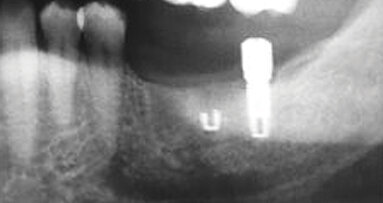 Intro to CBCT as it pertains to prevention of failures in oral implantology