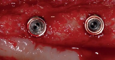 Histomorphometric analysis of bone healing at implants with turned or rough surfaces: An experimental study in the dog