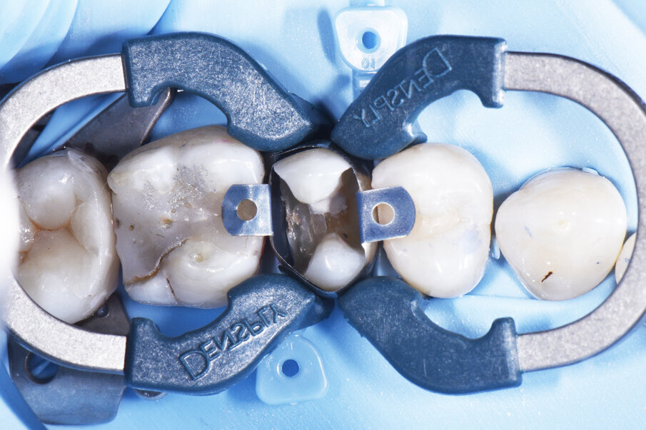 Zoomed out view showing diametrically-opposing Palodent® V3 rings with Palodent® V3 matrices overlapping each other in a one-step solution driving the rebuilding of proximal and axial contours predictably.  