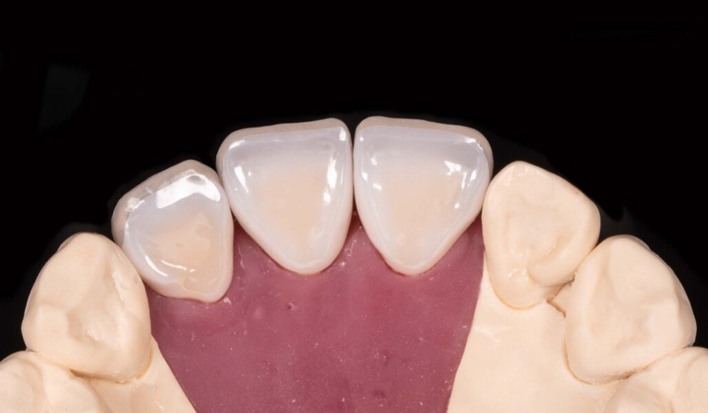 Fig. 7: Palatal view of the crowns on the model.