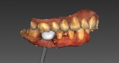 Cyfrowe techniki projektowania w estetycznych ostatecznych uzupełnieniach implantoprotetycznych