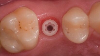 Impianti in Zirconia: una diversa risposta biologica al biofilm batterico