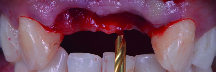 Fig. 14 : Foret-guide. 