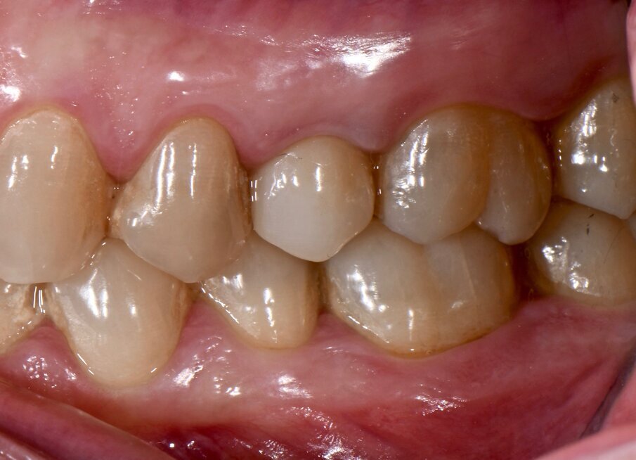 Fig. 1c - Condizione clinica al baseline: III e IV sestante.