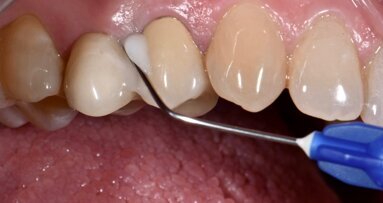 Effetti clinici dell’applicazione sottogengivale di un gel a base di Xantano e Clorexidina nel trattamento delle malattie peri-implantari