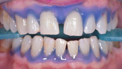 Tecnologia innovativa  per lo sbiancamento: pratica clinica che migliora la vita  di relazione della persona assistita. Case report