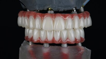 Ridefinire la riabilitazione full-arch: la rivoluzione del workflow digitale nell’implantologia