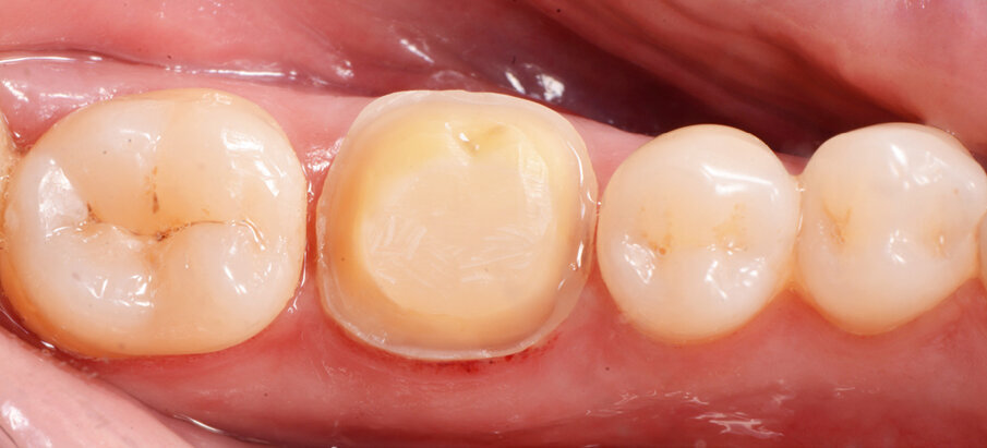 Fig. 2: Situation after composite build-up (Tetric N-Ceram Bulk Fill) and preparation