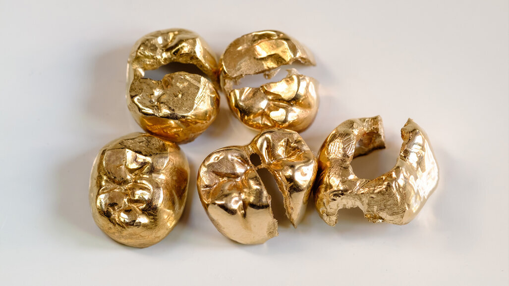 Zum Welttag des Sehens rufen Schweizer zu Zahngoldspenden für Augenoperationen auf