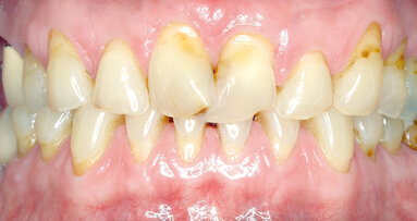 Vita Suprinity: un caso clinico