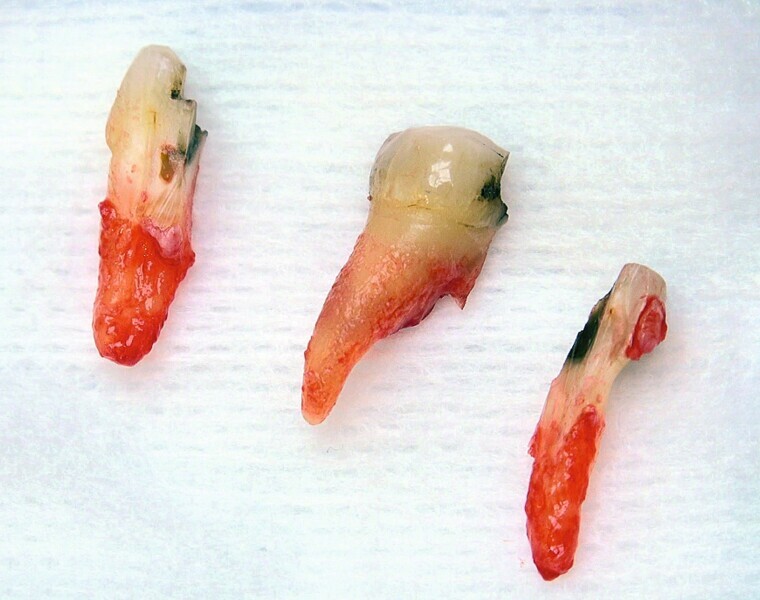 Fig. 49 : Extraction atraumatique et préservation du septum inter-radiculaire. 