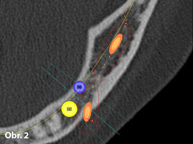 Navigovaná implantace do tenké čelisti