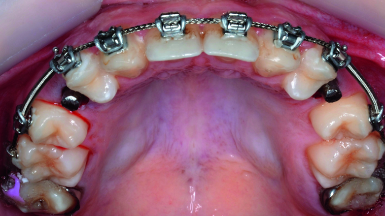 Orthodontic management of maxillary lateral incisors agenesis