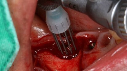 Une nouvelle procédure chirurgicale peut aider à combattre la péri-implantite