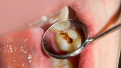 Could zinc make cavity treatment simpler, painless and drill-free?