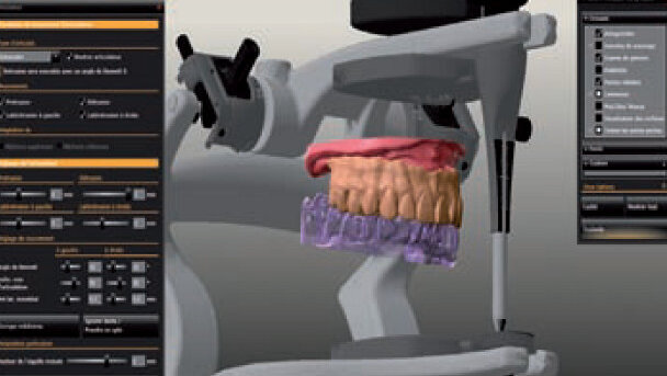 Réhabilitation totale Zircone Prettau® sur piliers implantaires télescopes avec le système CAD/CAM 5-TEC Zirkonzahn