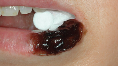 Stress ossidativo e gel gengivale NBF