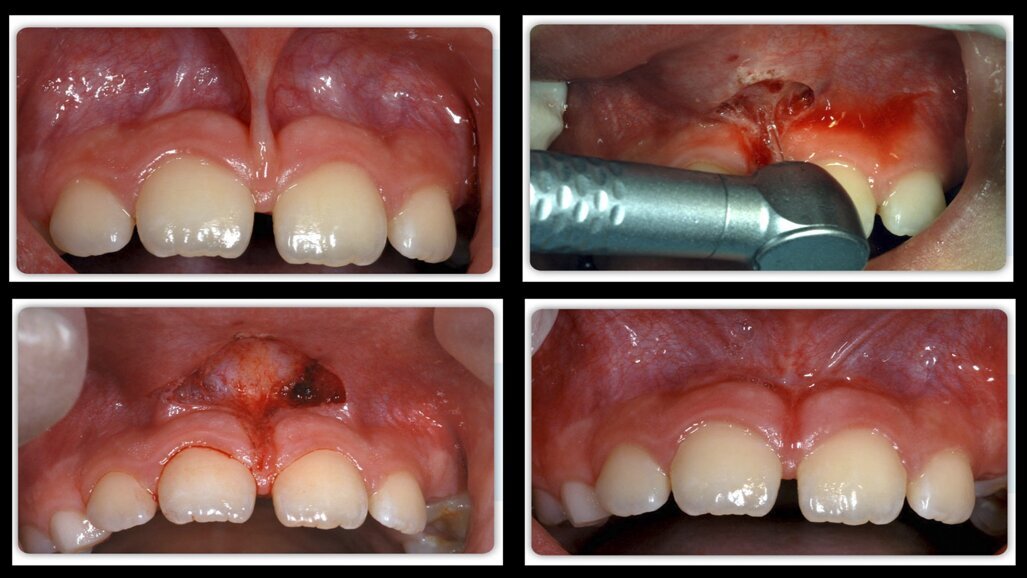 Las matronas no pueden realizar frenectomías   