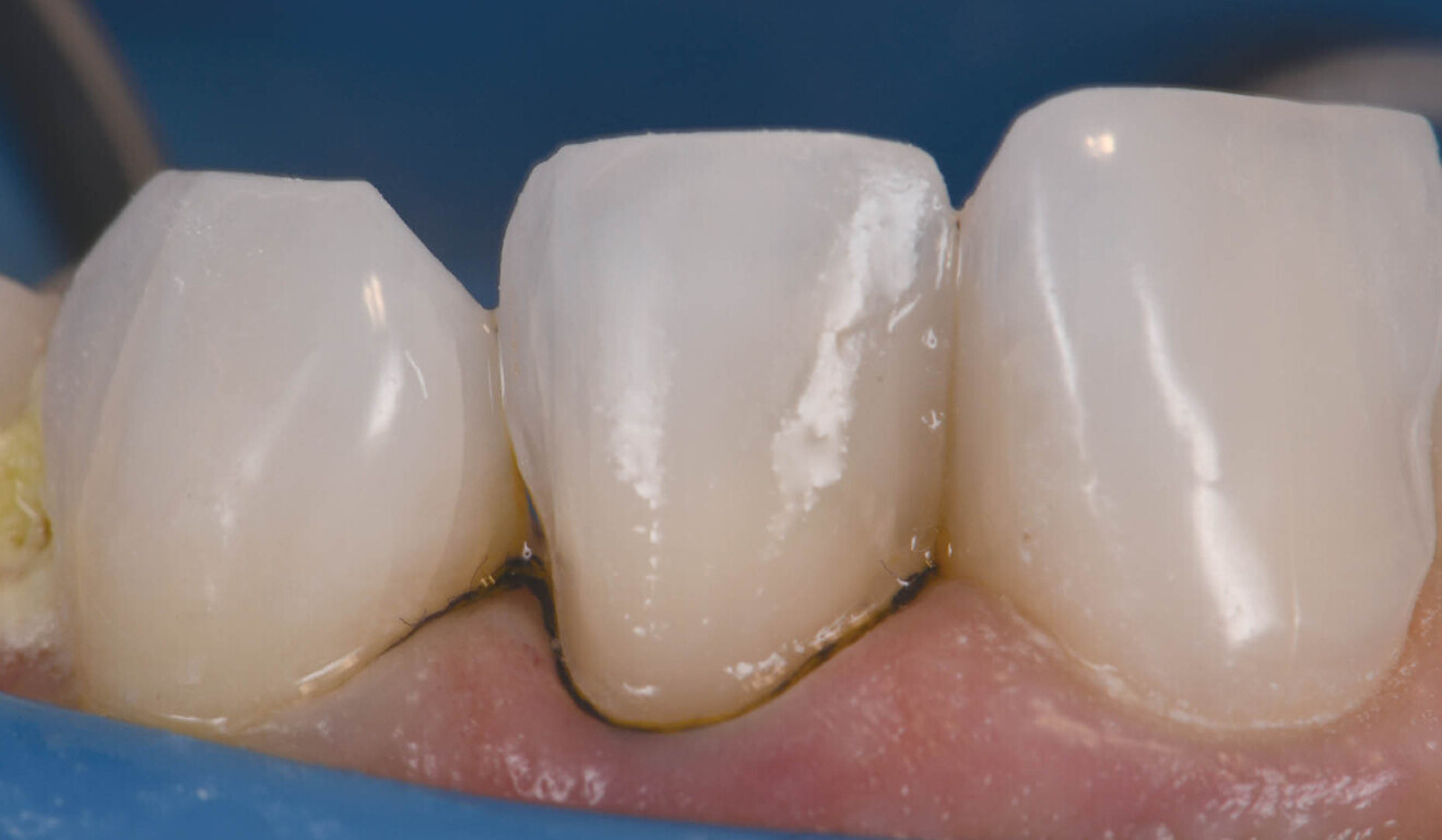 Figs. 2a & b: Veneer preparation of teeth #12 and 22.
