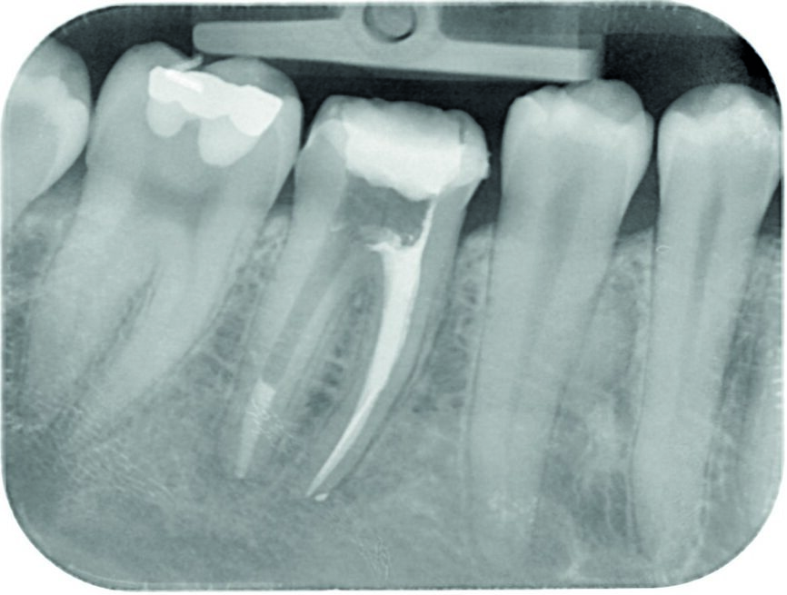 Fig. 4: Obturation of mesial canals and a 5 mm apical plug of MTA distally