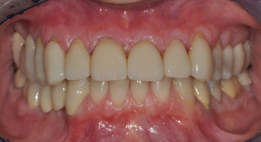 Figs. 13 and 14: Final restorative result after adhesive cementing