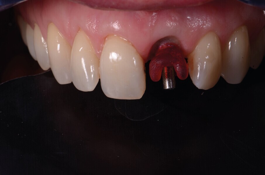 Fig. 18 : Le transfert d’empreinte est vissé sur l’implant. 