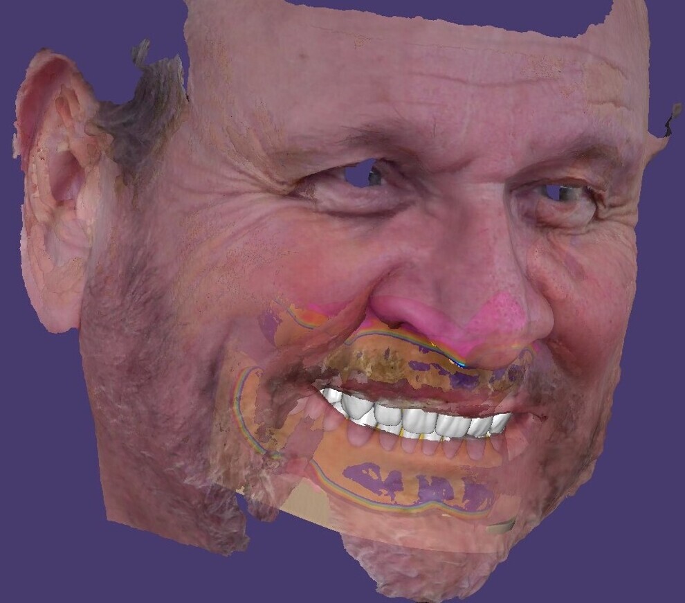 Fig. 13: Face scan in exocad 3.1 Rijeka.