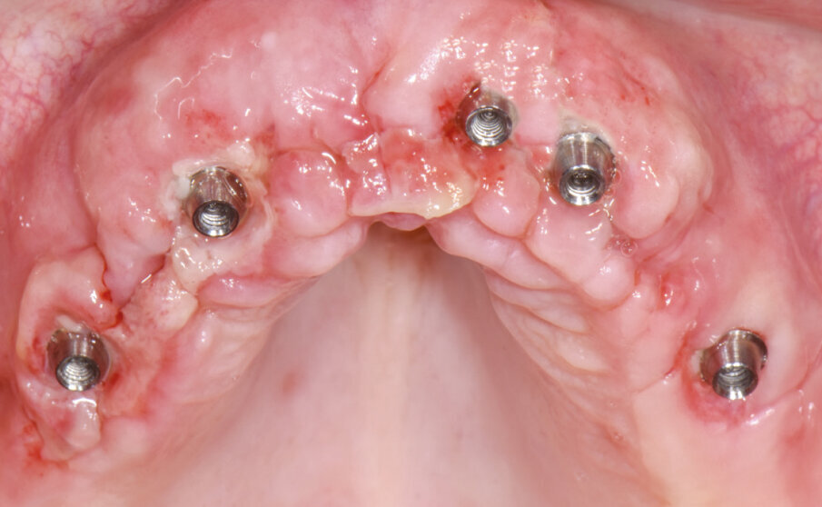 Fig. 13 - Rimozione suture (a 7 giorni dall’intervento chirurgico).