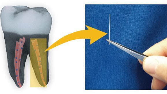 Cientistas testam novos biomateriais de nanodiamantes para tratamento de canal radicular