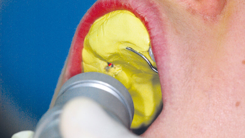 Svařování v ordinaci pomocí Nd:YAG laseru