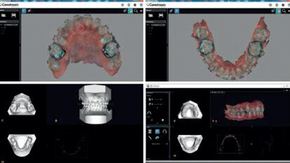 Utilizzo delle impronte digitali per migliorare il flusso di lavoro ortodontico