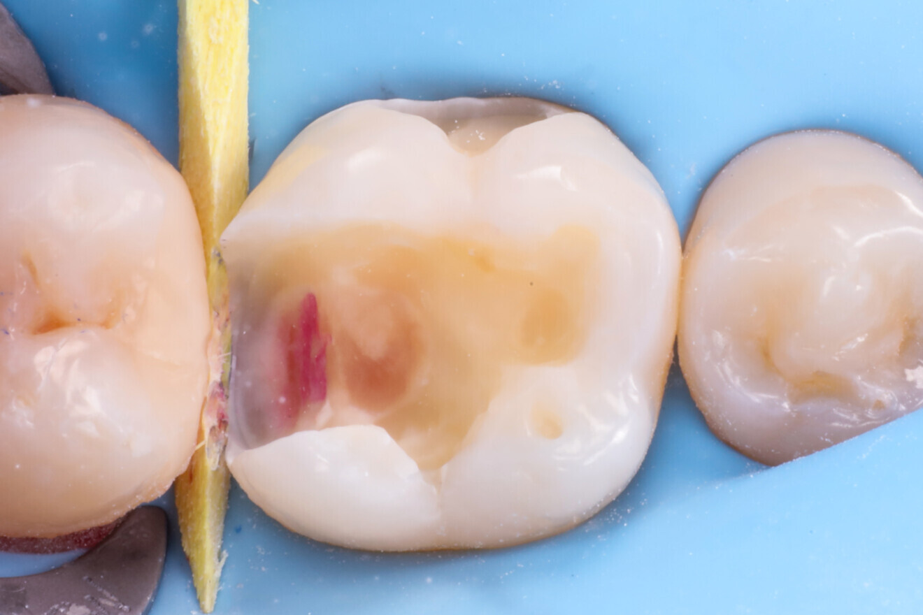 Fig. 6: Cavity after air abrasion.