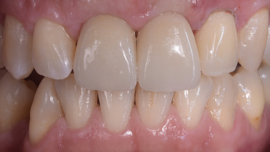 Fig. 3_Provvisorio in PMMA, incrementando il profilo emergente dell’elemento 11 è stato possibile allineare la parabola gengivale portandola alla stessa altezza del elemento 21.