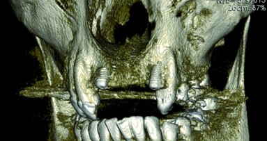 One week diary with our X-Mind Trium 3D CBCT in practice