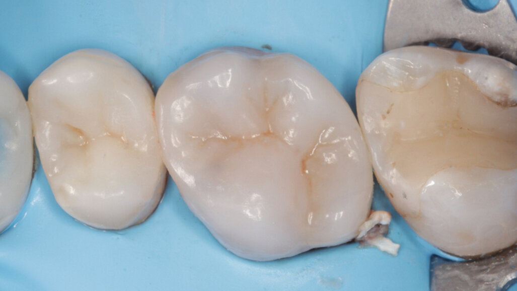 Direct cuspal coverage with resin composite