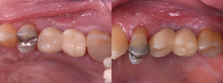 Fig. 8 - La protesi provvisoria.