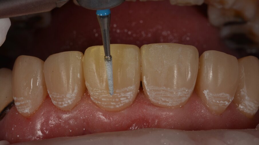 Tertiaire anatomie werd aangebracht met behulp van een traagdraaiende diamantboor zonder waterkoeling.
