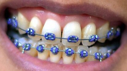 Aparat ortodontyczny – nie tylko dla dzieci i młodzieży