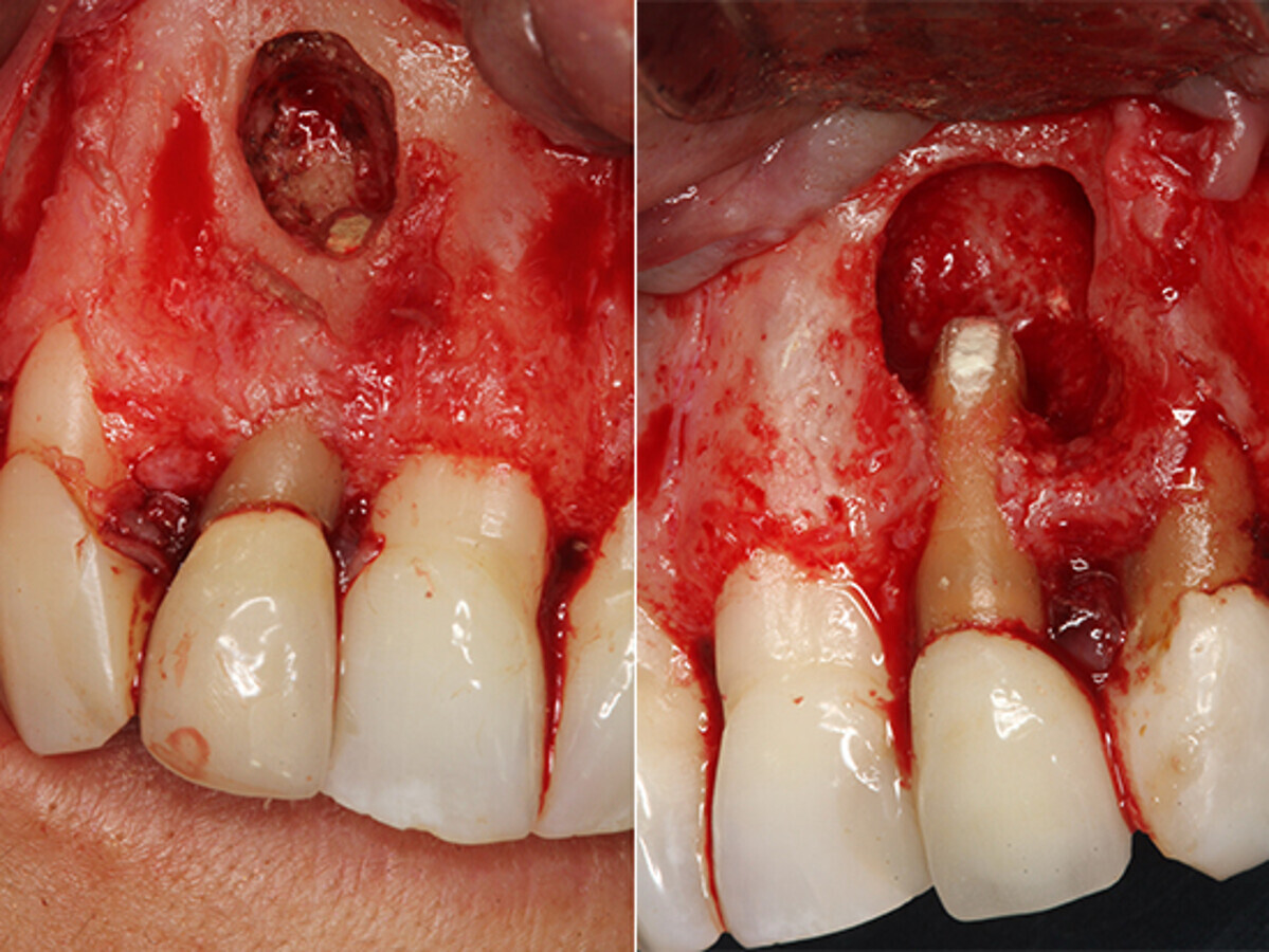 Figura 5. Imagen del 1.2 tras el sellado con MTA de la cavidad retrÃ³grada. Figura 6. Imagen del 2.2 tras el sellado con MTA y donde se aprecia el defecto apicomarginal en la cara vestibular de la raÃ­z.