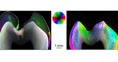 Nanoforscher untersuchen Karies