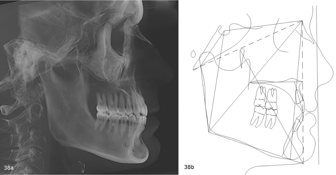 Figs. 38a & b: Pretreatment cephalometric radiograph (a) and tracing (b).