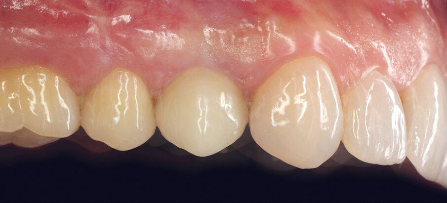 Fig. 39: Check-up after 5 years is proof to the long-term stability of this treatment concept.