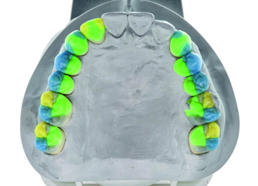 Fig. 1b : Conception de l’occlusion fonctionnelle par guidage séquentiel selon le professeur Rudolf Slavicek. 