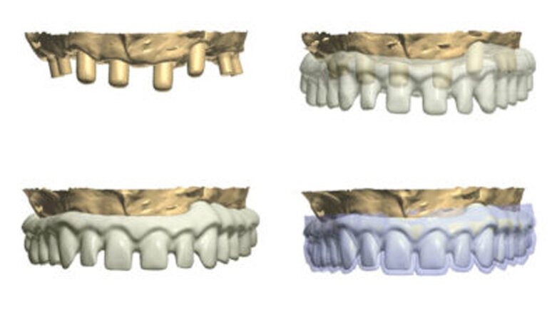 The use of CBCT and CAD/CAM techniques in implant-supported rehabilitation of maxilla—Part II