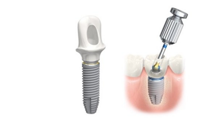 Компания Nobel Biocare представляет имплантаты NobelParallel Conical Connection